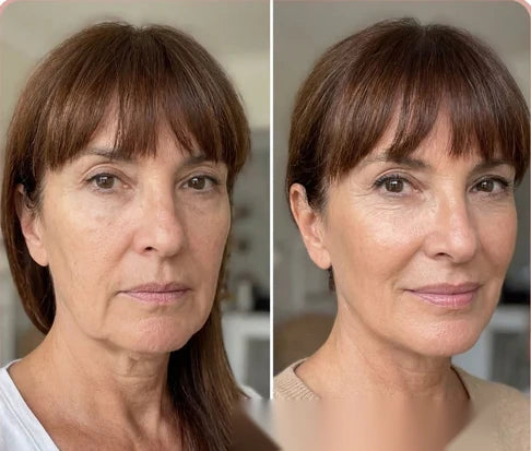 Antes y después — óvalo facial descolgado